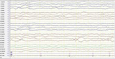 Anti-U1RNP-70kD-positive case of neonatal lupus presenting with seizure and incomplete heart block: a case report and literature review